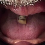 השתלת שיניים לפני