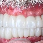 השתלת שיניים אחרי