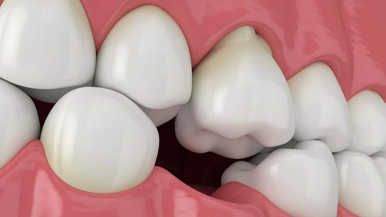 שיקום שיניים שחוקות